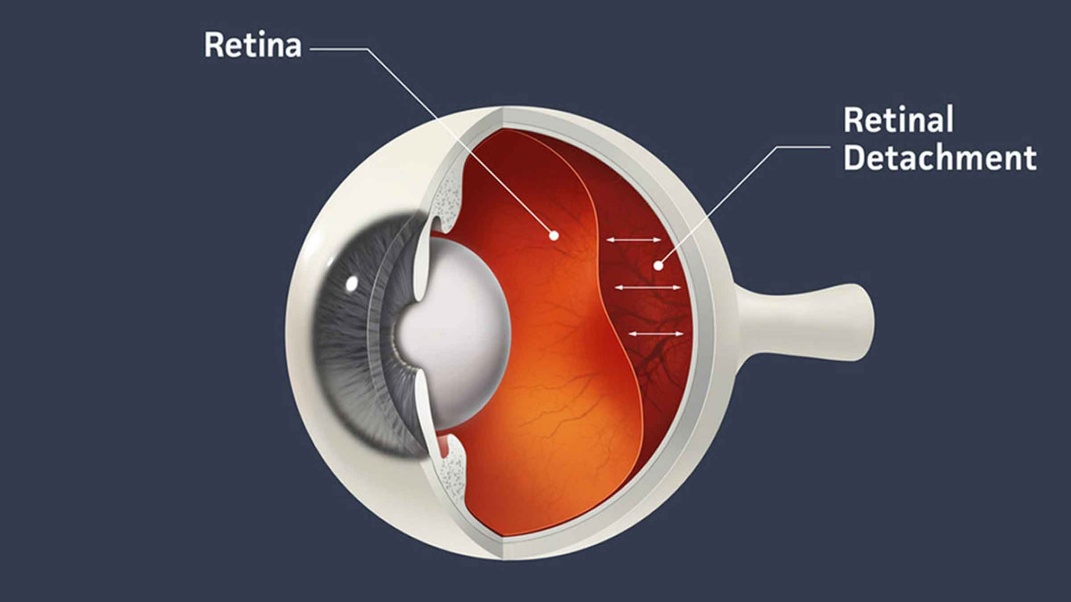 Retinal Detachment Causes, Symptoms, and Treatments – Explained ...