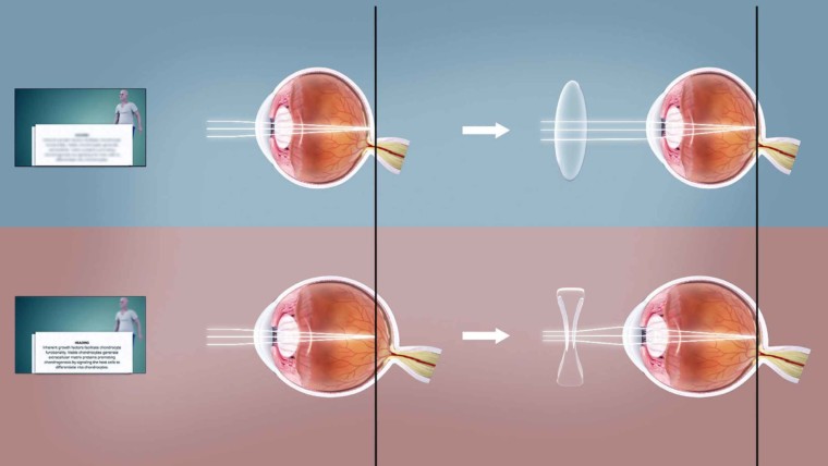 What You Need To Know About Refractive Errors