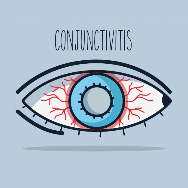 All You Need To Know About Allergic Conjunctivitis Eye Drops