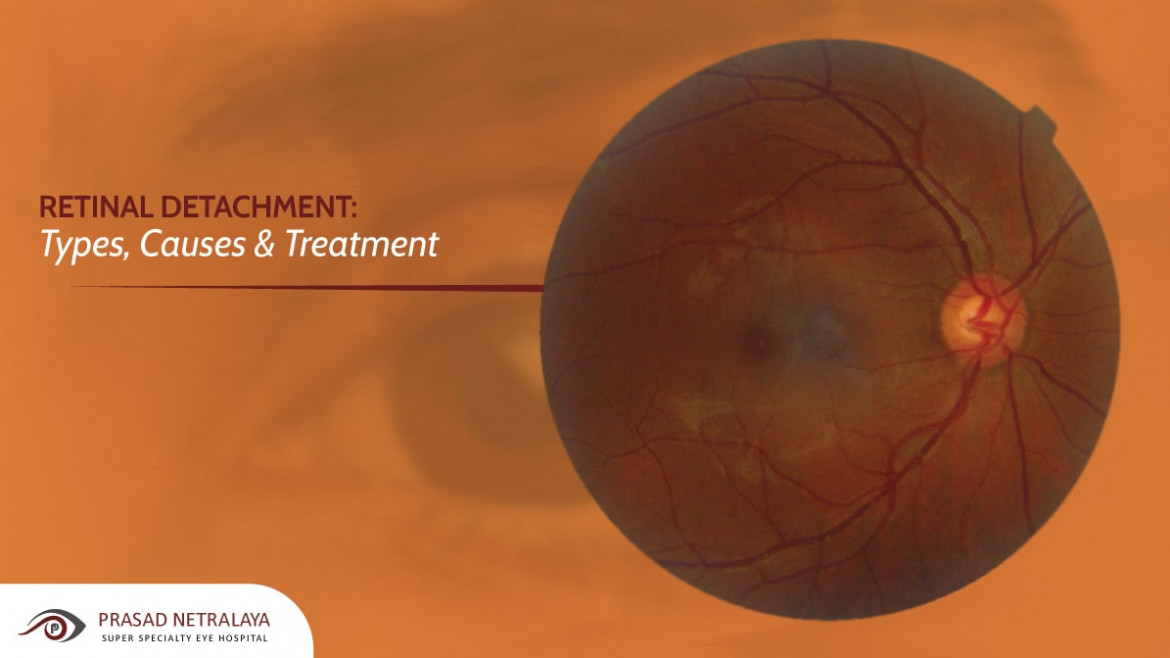 Retinal Detachment: Types, Causes & Treatment