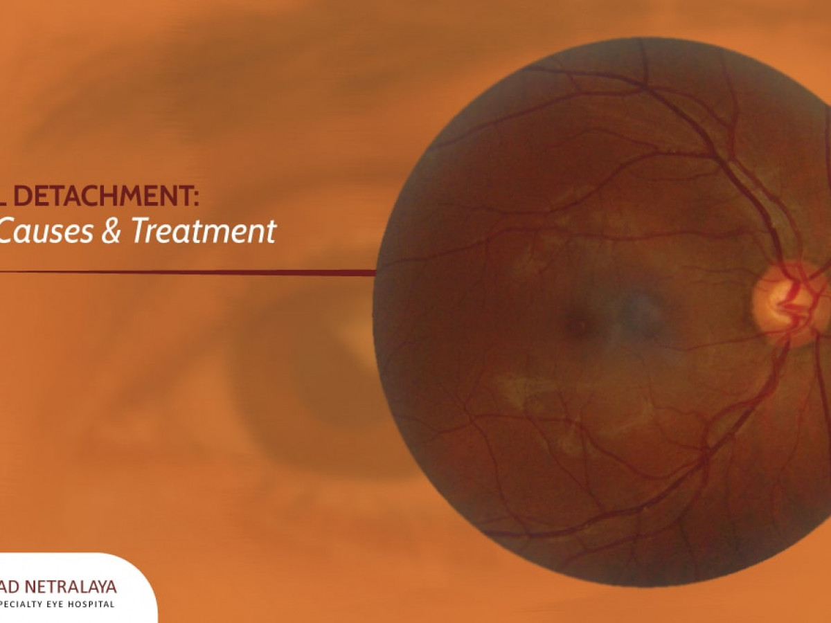 Types of Retinal Detachment, Their Causes, and Treatments