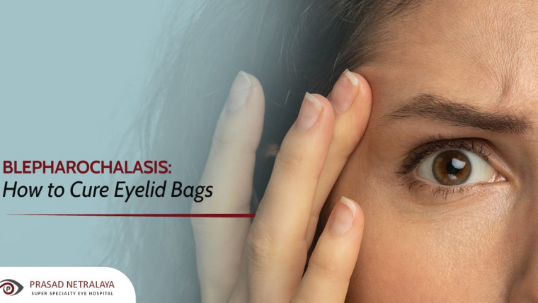 Blepharochalasis: How to Cure Eyelid Bags