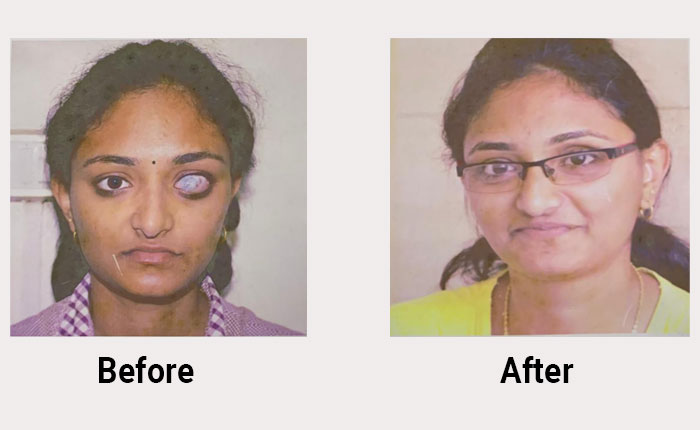 Oculoplasty