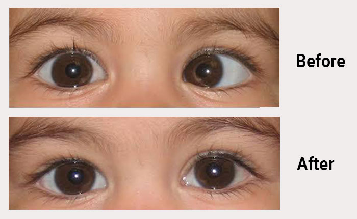 Squint Eye Correction