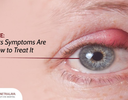 Eye Stye: What Its Symptoms Are and How to Treat It