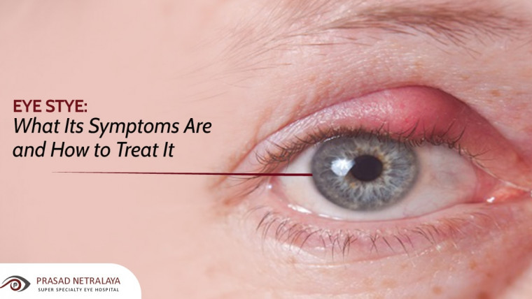 Eye Stye: What Its Symptoms Are and How to Treat It
