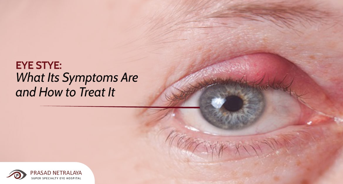 Eye Stye: What Its Symptoms Are and How to Treat It