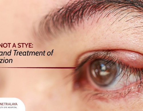 No, It’s Not a Stye: Causes and Treatment of a Chalazion