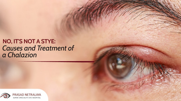 No, It’s Not a Stye: Causes and Treatment of a Chalazion