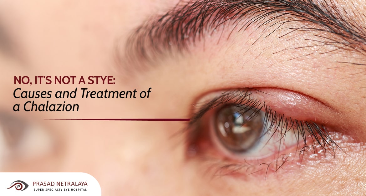 No, It’s Not a Stye: Causes and Treatment of a Chalazion