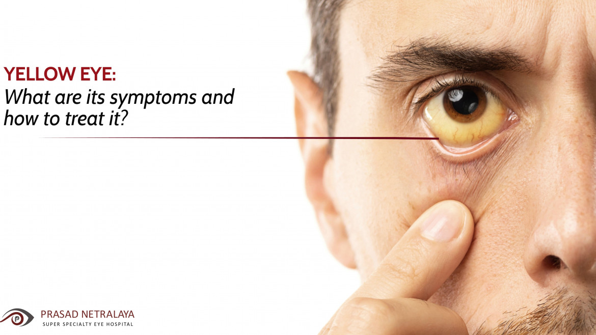 Yellow Eye: What Are Its Symptoms and How to Treat It?