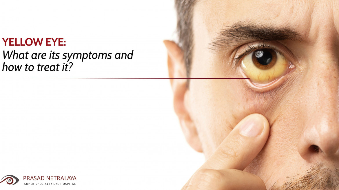 What Causes Yellow Eyes or Jaundice Eyes? Know All About This Eye Condition