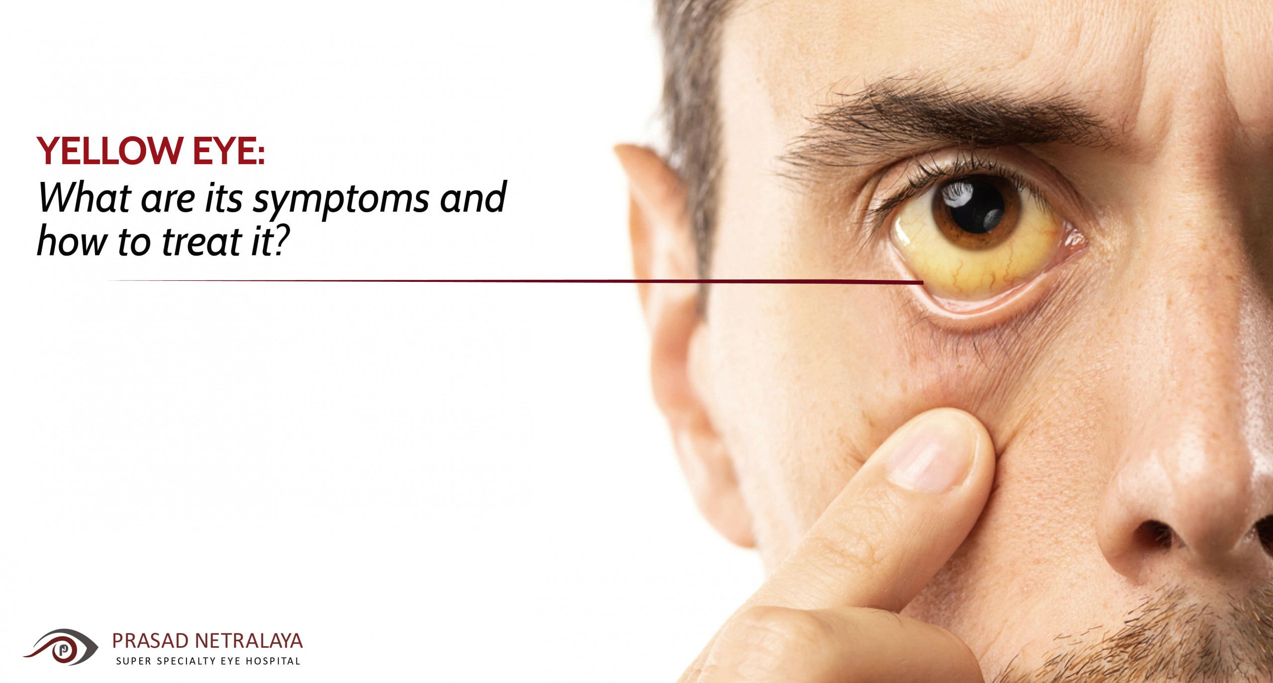 Yellow Eyes: Common Causes and When to See a Doctor