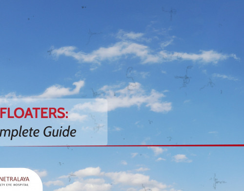 Eye Floaters: A Complete Guide