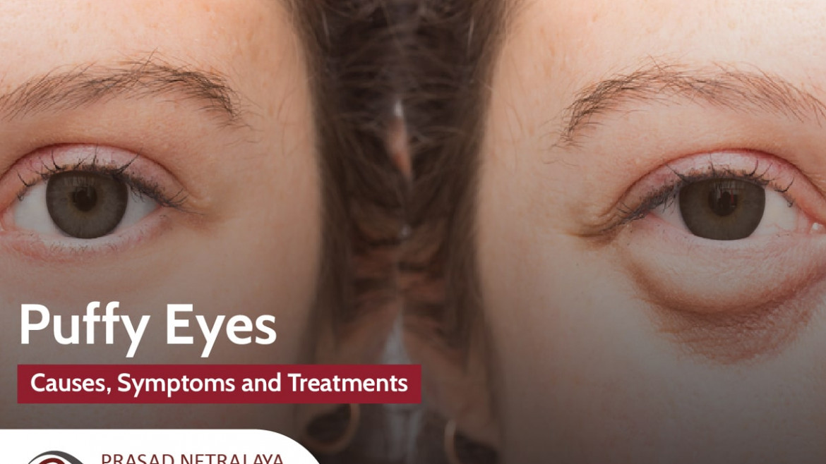 Causes, Symptoms and Treatments For Puffy Eyes