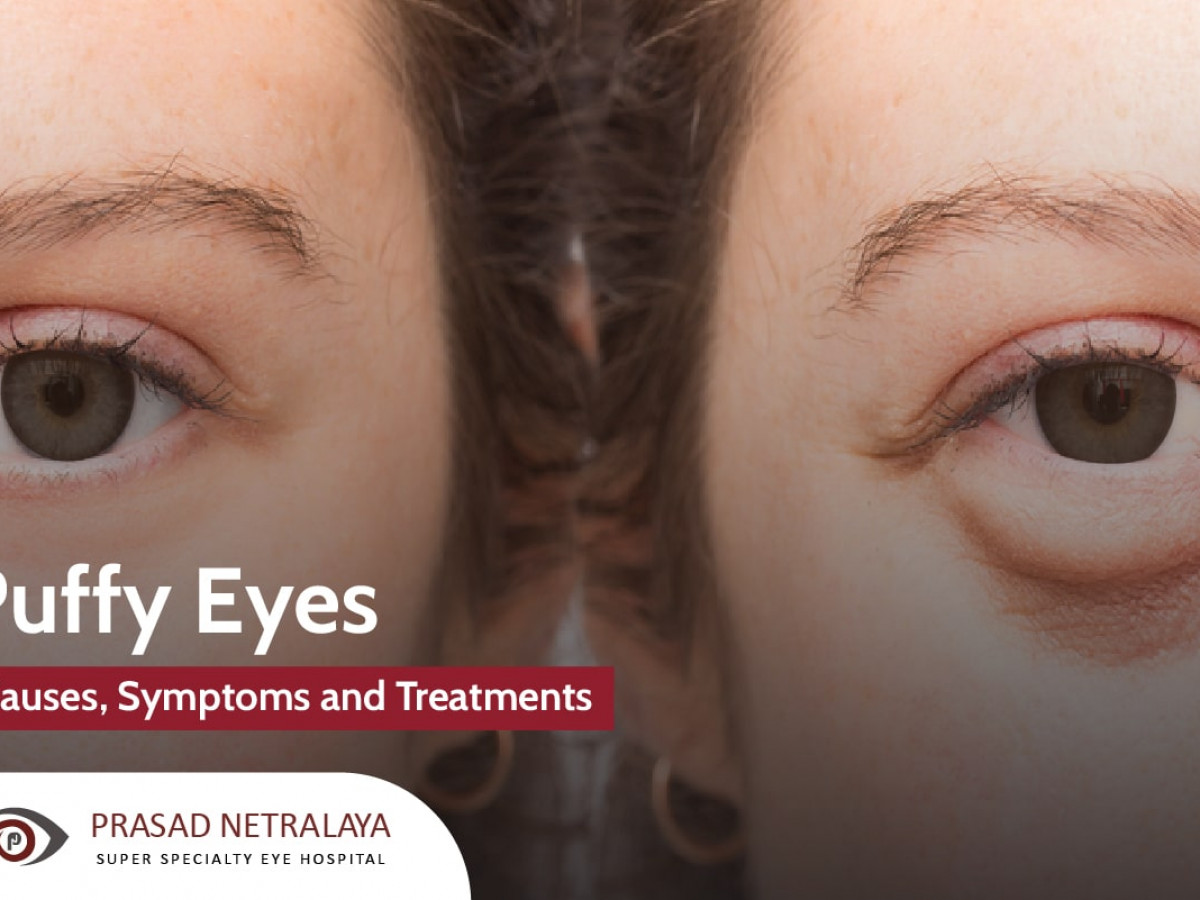 Causes, Symptoms and Treatments For Puffy Eyes