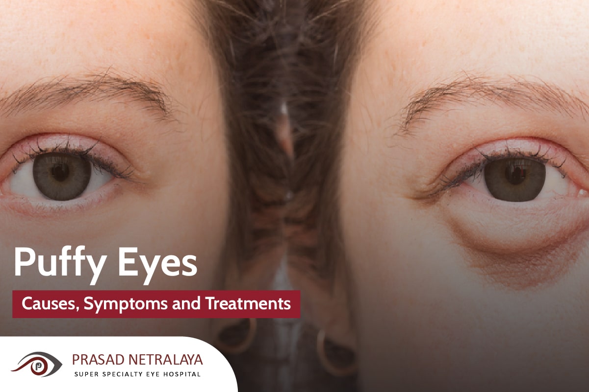 Causes, Symptoms and Treatments For Puffy Eyes