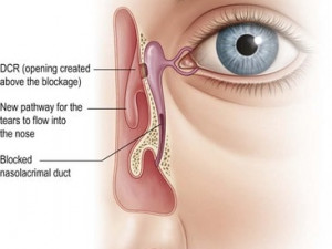 dacryocystorhinostomy