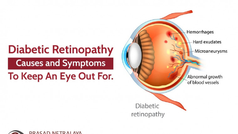 Diabetic Retinopathy: Causes and Symptoms to Keep an Eye Out For