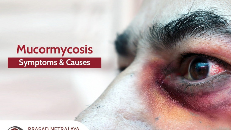 An Overview of Black fungus A.K.A Mucormycosis