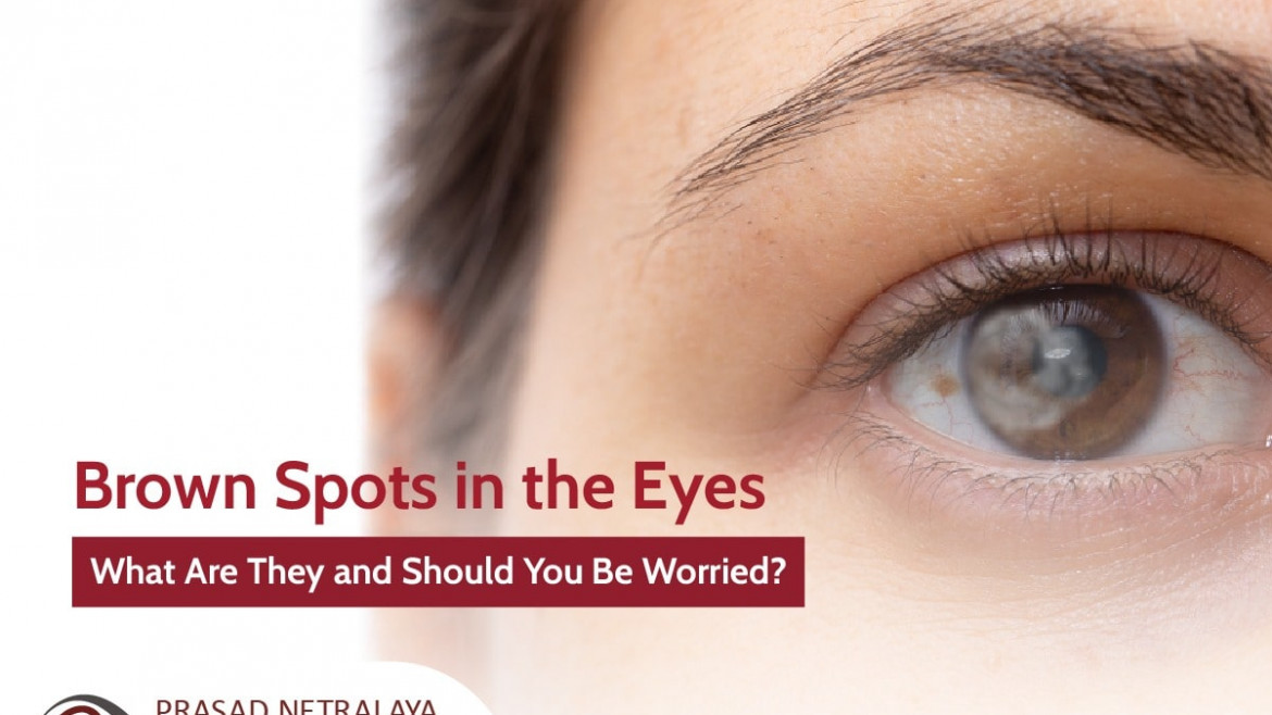 brown-spots-in-the-eyes-what-are-they-and-should-you-be-worried