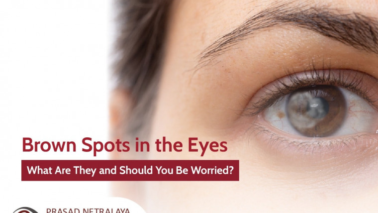 Brown Spots in the Eyes 一 What Are They and Should You Be Worried?