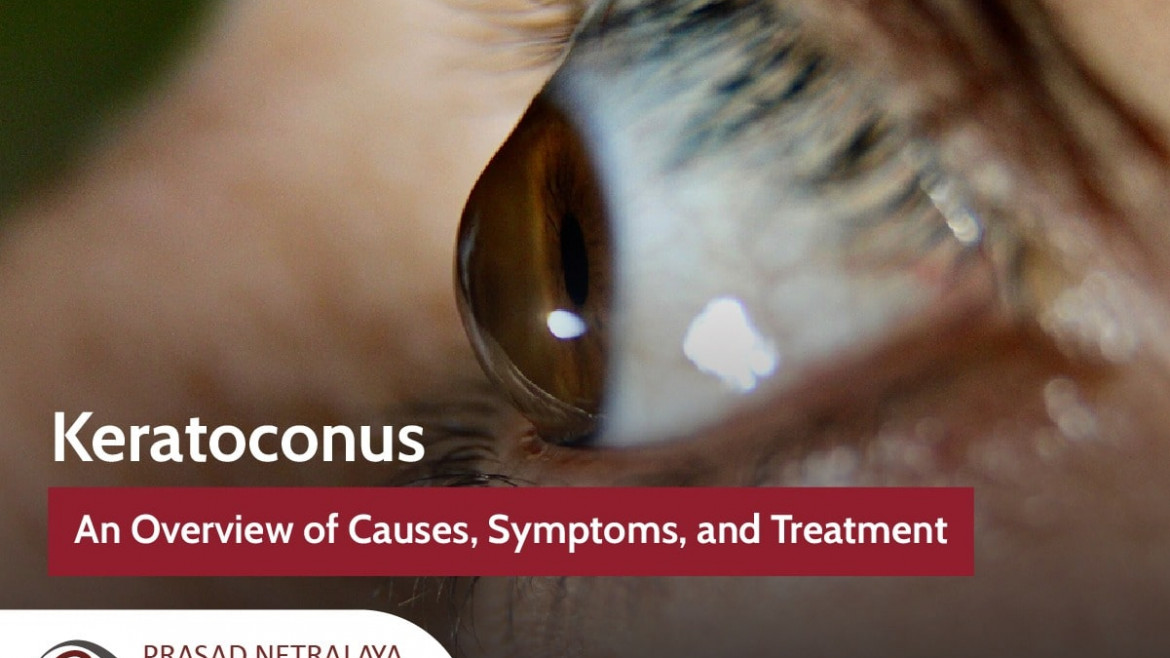 Keratoconus: An Overview of Causes, Symptoms and Treatments