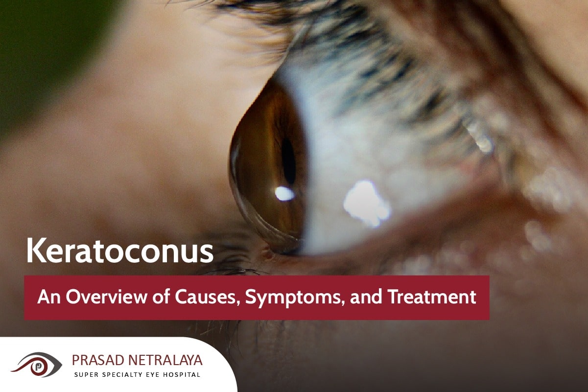 Keratoconus: An Overview of Causes, Symptoms and Treatments