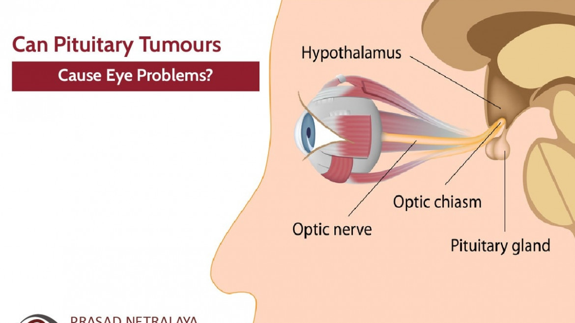 Can Pituitary Tumours Cause Eye Problems?