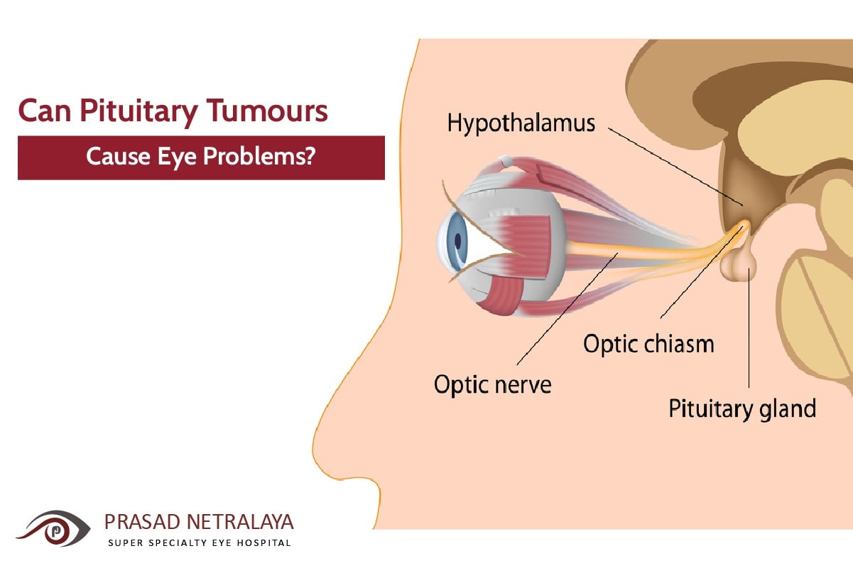 Can Pituitary Tumours Cause Eye Problems 