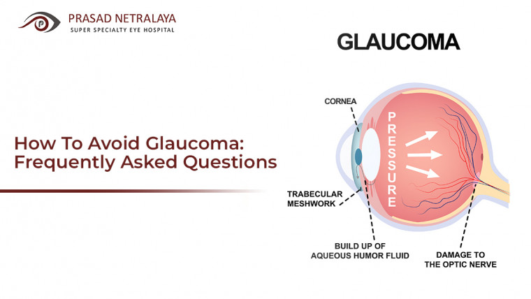 How To Avoid Glaucoma: Frequently Asked Questions