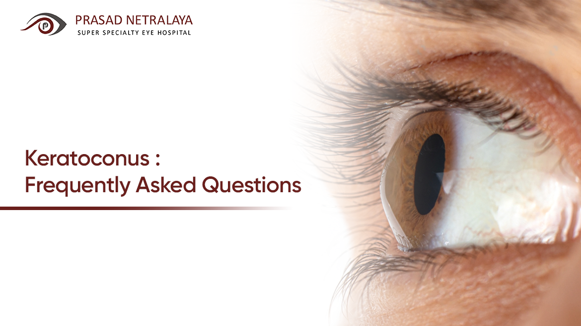 Keratoconus: Frequently Asked Questions