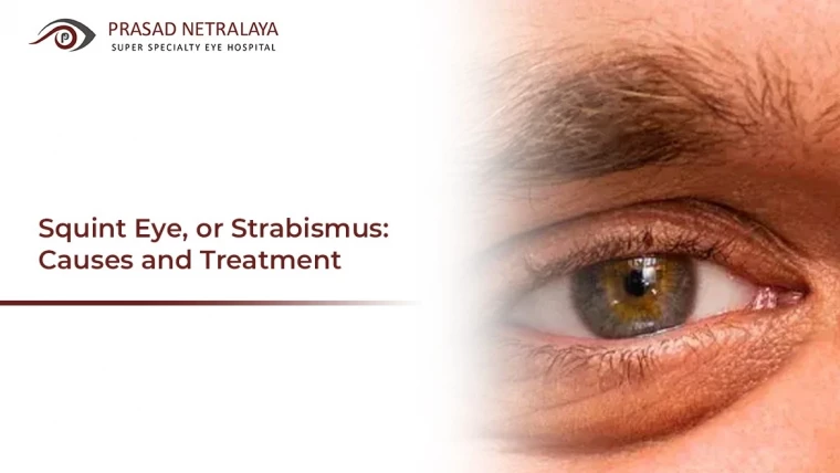 Squint Eye, or Strabismus: Causes and Treatment.