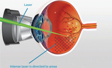 Laser-Treatment