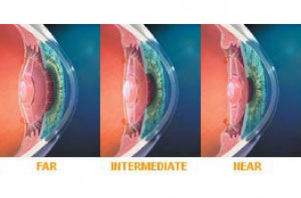 Multifocal IOL (1)