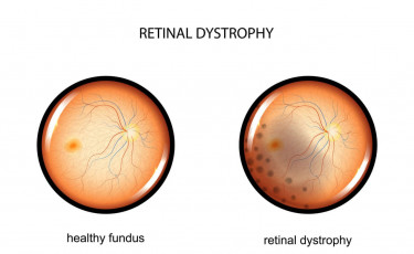 Retinal destrophy