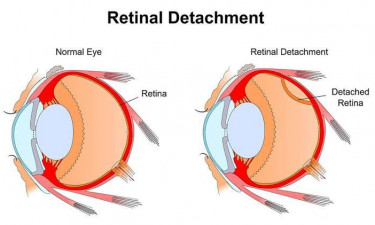 Retinal detachment