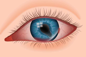 CORNEAL EMERGENCY-service