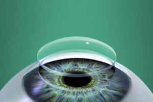 CORNEAL TRANSPLANTATION -service