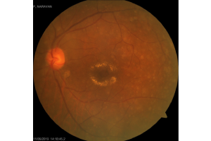 RETINAL DYSTROPHY-service