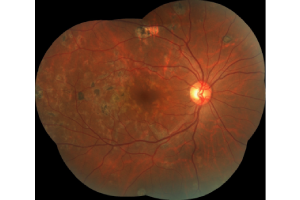 RETINAL VASCULITIS -service