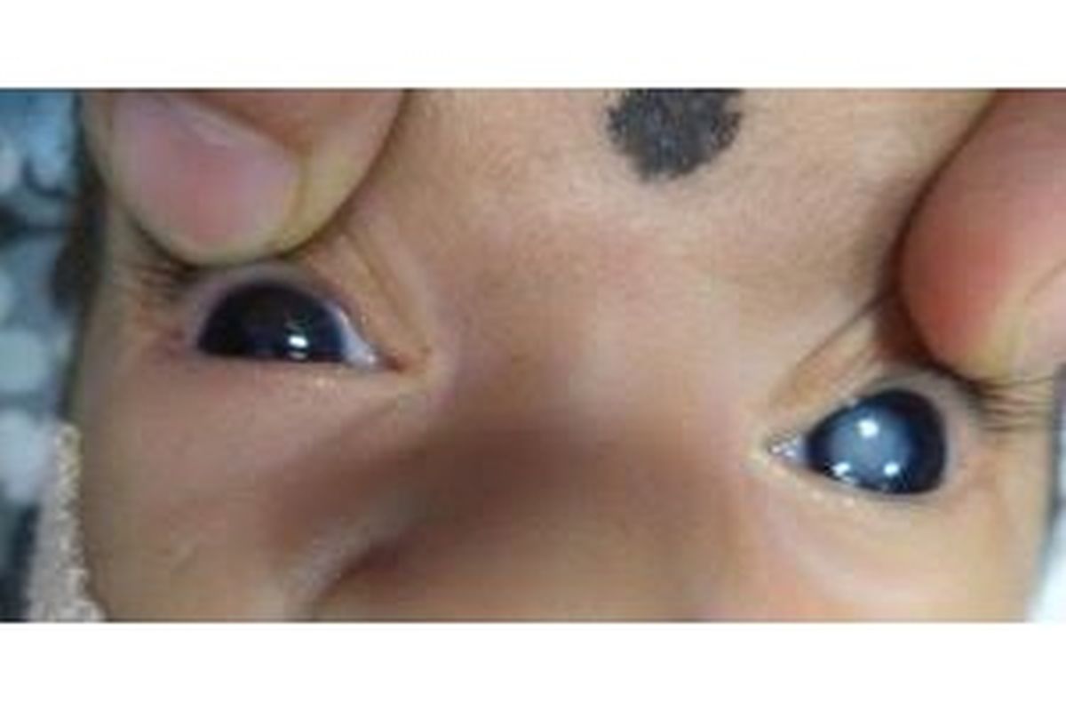 congenital eye disease